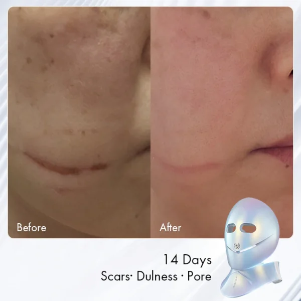 Chouchou Radiance LED Mask - Image 3